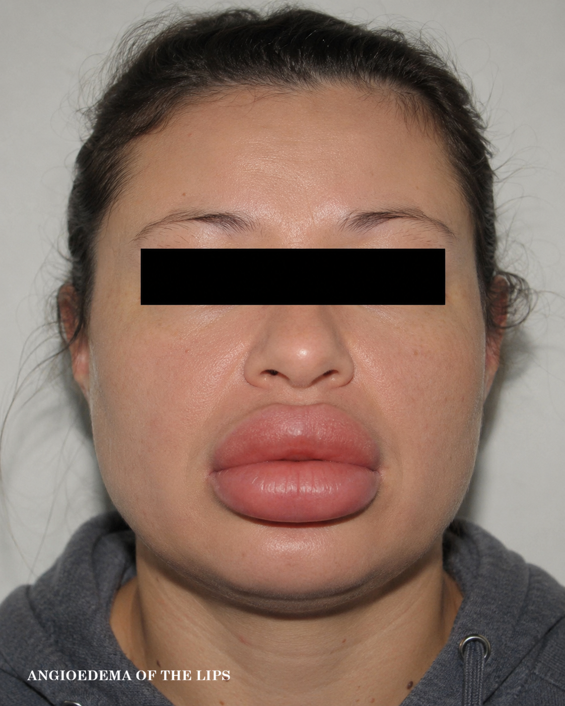 Example of angioedema affecting the lips